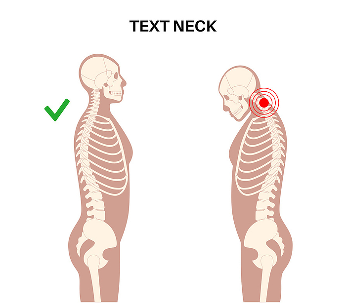 Neck vertebrae deformity, illustration Neck vertebrae deformity, illustration., by PIKOVIT   SCIENCE PHOTO LIBRARY