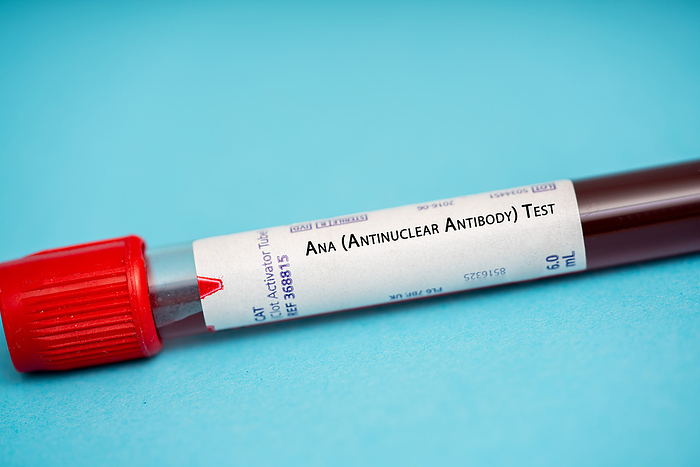 Antinuclear antibody test Ana  antinuclear antibody  test. This test measures the levels of antibodies that attack the nuclei of cells. It is used to diagnose autoimmune diseases such as lupus., by WLADIMIR BULGAR SCIENCE PHOTO LIBRARY