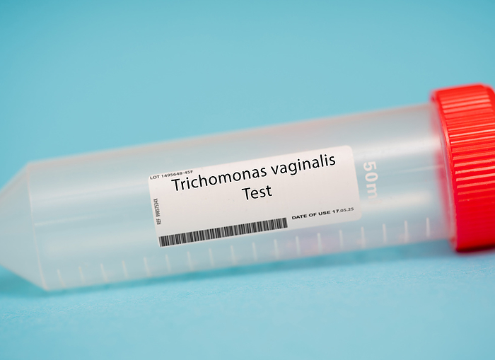 Trichomonas vaginalis test Trichomonas vaginalis test. This test is used to detect the presence of the trichomonas vaginalis parasite, which can cause vaginal infections. A sample of vaginal discharge is collected and sent to a laboratory for analysis., by WLADIMIR BULGAR SCIENCE PHOTO LIBRARY