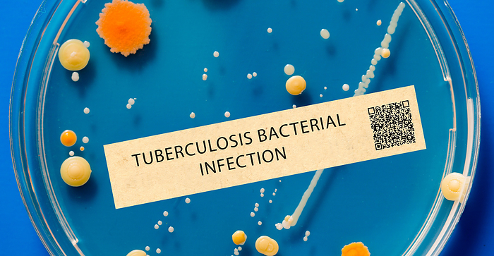 Tuberculosis bacterial infection Tuberculosis. This is a bacterial infection that usually affects the lungs and is spread through the air., by WLADIMIR BULGAR SCIENCE PHOTO LIBRARY