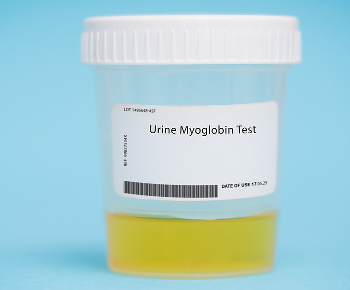 Urine myoglobin test Urine myoglobin test. This test measures the levels of myoglobin, a protein found in muscle tissue, in the urine. It is used to diagnose and monitor certain medical conditions, such as rhabdomyolysis, a breakdown of muscle tissue that can lead to kidney damage., by WLADIMIR BULGAR SCIENCE PHOTO LIBRARY