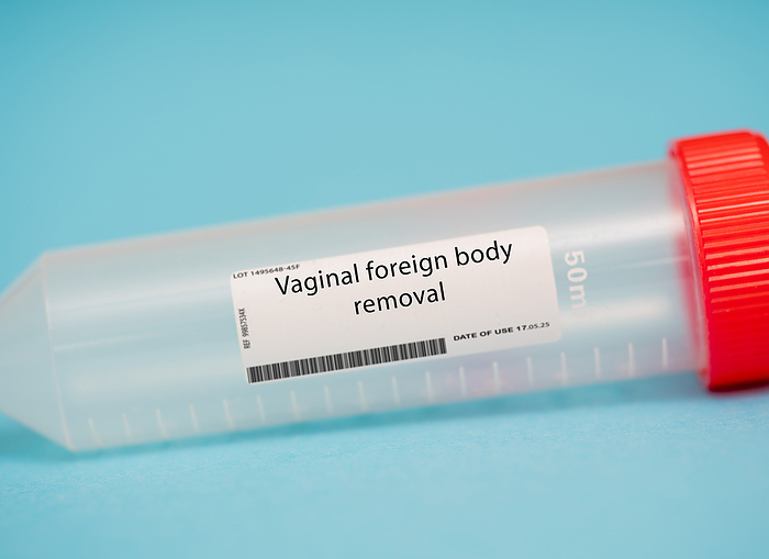 Vaginal foreign body removal Vaginal foreign body removal. This procedure involves the removal of a foreign object from the vagina, such as a tampon or condom, which can cause infection or other complications if left in place., by WLADIMIR BULGAR SCIENCE PHOTO LIBRARY