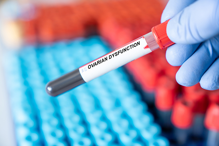 Ovarian dysfunction blood test Ovarian dysfunction blood test., by WLADIMIR BULGAR SCIENCE PHOTO LIBRARY