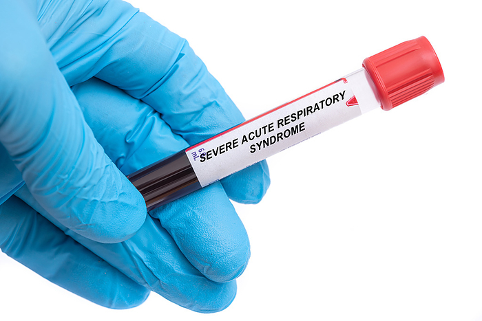 Severe acute respiratory syndrome blood test Severe acute respiratory syndrome blood test., by WLADIMIR BULGAR SCIENCE PHOTO LIBRARY