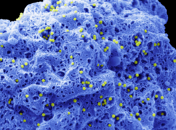 Adenovirus, SEM Scanning electron micrograph  SEM  of a human alveolar basal epithelial cell  A549 cell line  infected with Human adenovirus strain J.J. subtype D 10  HAdV 10  virus. The cell has been infected with HAdV 10 for 3 days and is in the process of undergoing lysis, releasing intracellular synthesised viral particles through pores in the plasma membrane  100nm yellow particles . Adenoviruses are a group of viruses that can cause mild to severe infection throughout the body. Adenovirus infections most commonly affect the respiratory system, eyes, and the gastrointestinal tract. These infections can cause symptoms similar to the common cold and flu or pneumonia, conjunctivitis, or acute gastroenteritis. Most adenovirus infections are mild. Magnification: x10000 when printed 10 centimetres wide. Specimen courtesy of Virology Research Services Ltd  Scott Lawrence ., by STEVE GSCHMEISSNER SCIENCE PHOTO LIBRARY