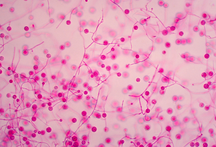 Histoplasma capsulatum fungus, light micrograph Light micrograph showing Histoplasma capsulatum fungus in its mycelial form. Depending on ambient temperature Histoplasma can form a unicellular yeast, or a multicellular mycelium as seen here. Multiple macroconidia, a form of asexual spore, can be seen as circles connected by hair like hyphae  fungal filaments . This fungus is mostly found in soil, especially where bat and bird droppings are present. The spores can causes the disease histoplasmosis when inhaled. In most cases, people are not affected when they inhale these spores, but in some cases develop a fever, cough, and fatigue which typically self resolve. In rare cases, particularly when patients are immunosuppressed, severe histoplasmosis can develop, and potentially affect almost any part of the body. This can lead to respiratory or bone marrow failure which can be fatal. Antifungal medication is the typical treatment course when necessary., by CDC, Dr. Libero Ajello SCIENCE PHOTO LIBRARY