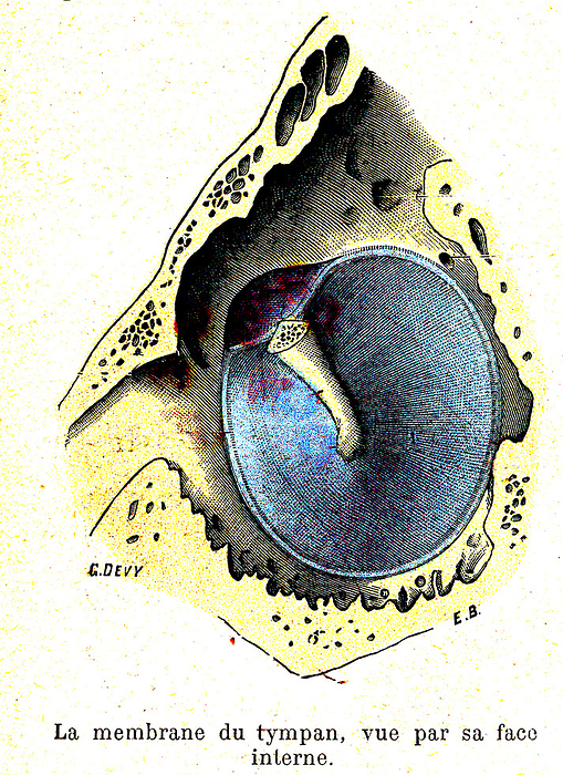 Eardrum, illustration Illustration of the eardrum, or tympanic membrane, seen from inside the ear. The eardrum separates the external ear from the middle ear. When sound impacts it, it vibrates and transmits that sound to the ear bones which in turn transmit the sound onwards to the inner ear. The white structure is part of the hammer  malleus , the first of the three small bones that connect the membrane to the inner ear. From Traite d Anatomie Humaine  1905  by French anatomist Leo Testut  1849 1925 ., by COLLECTION ABECASIS SCIENCE PHOTO LIBRARY