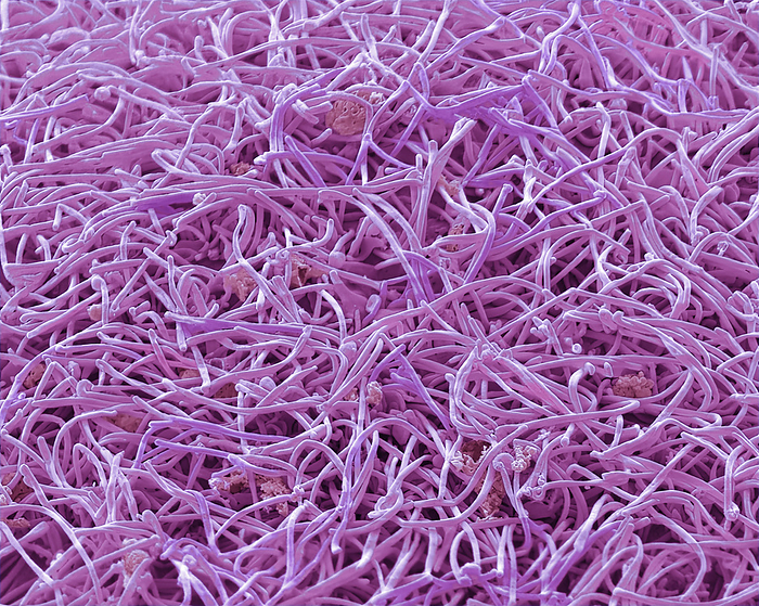 Human Metapneumovirus  HMPV , SEM Human Metapneumovirus  HMPV  strain isolate TN 93 32 group B2. Scanning electron micrograph  SEM  of an African Green Monkey Kidney Epithelial cell  Vero cell line  infected with HMPV for 3 days. The image shows a sea of long filamentous enveloped particles  pink  obscuring the plasma membrane of the infected cells. These infections can cause  cold like  symptoms similar to other viruses that cause upper and lower respiratory infections  RSV, Rhinovirus, Influenza  ranging from mild symptoms such as cough, fever, nasal congestion, and shortness of breath to more severe bronchitis or pneumonia. Magnification: 5000 x when printed 10 centimetres wide. Specimen courtesy of Virology Research Services Ltd  Scott Lawrence ., by STEVE GSCHMEISSNER SCIENCE PHOTO LIBRARY