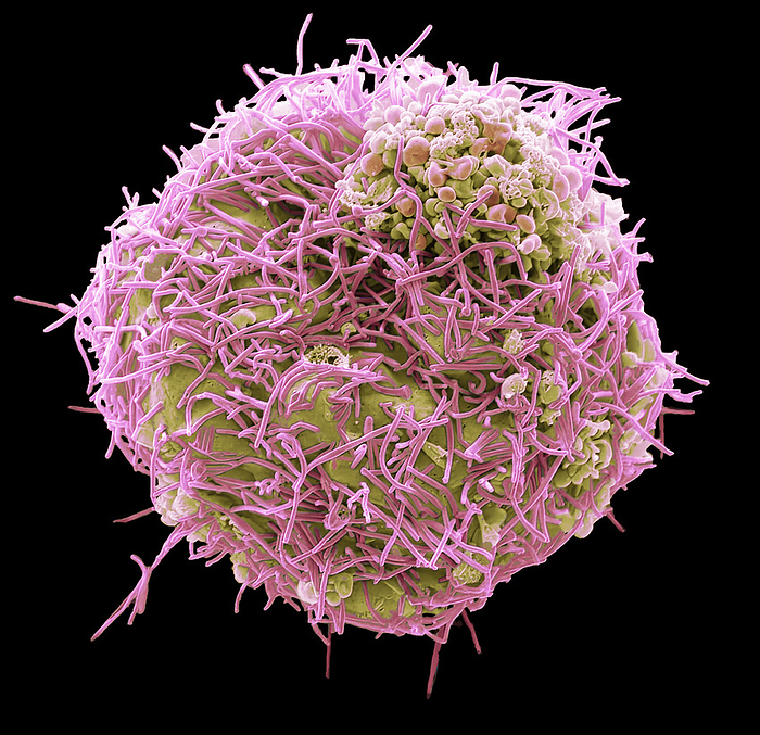 Human Metapneumovirus  HMPV , SEM Human Metapneumovirus  HMPV  strain isolate TN 93 32 group B2. Scanning electron micrograph  SEM  of an African Green Monkey Kidney Epithelial cell  Vero cell line  infected with HMPV for 3 days. The image shows an infected cell with long filamentous enveloped particles  pink  emerging from the plasma membrane. These infections can cause  cold like  symptoms similar to other viruses that cause upper and lower respiratory infections  RSV, Rhinovirus, Influenza  ranging from mild symptoms such as cough, fever, nasal congestion, and shortness of breath to more severe bronchitis or pneumonia. Magnification: 3000 x when printed 10 centimetres wide. Specimen courtesy of Virology Research Services Ltd  Scott Lawrence ., by STEVE GSCHMEISSNER SCIENCE PHOTO LIBRARY
