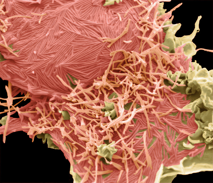Human Metapneumovirus  HMPV , SEM Human Metapneumovirus  HMPV  strain isolate TN 93 32 group B2. Scanning electron micrograph  SEM  of an African Green Monkey Kidney Epithelial cell  Vero cell line  infected with HMPV for 48 hours. The image shows an infected cell with long filamentous enveloped particles  red  emerging horizontally and vertically from the plasma membrane. These infections can cause  cold like  symptoms similar to other viruses that cause upper and lower respiratory infections  RSV, Rhinovirus, Influenza  ranging from mild symptoms such as cough, fever, nasal congestion, and shortness of breath to more severe bronchitis or pneumonia. Magnification: 6000 x when printed 10 centimetres wide. Specimen courtesy of Virology Research Services Ltd  Scott Lawrence ., by STEVE GSCHMEISSNER SCIENCE PHOTO LIBRARY