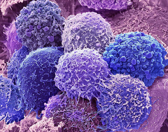 Hela cells, SEM HeLa cells. Coloured scanning electron micrograph  SEM  of a HeLa cells. HeLa cells are a continuously cultured cell line of immortal human cancer cells derived from cervical cancer cells. As they are immortal they thrive in the laboratory and are widely used in biological and medical research. Since being discovered in the 1950s, experiments on HeLa cells have played a role in developing advances like the polio and COVID 19 vaccines, treatments for cancer, HIV, AIDS, and much more. About 55 million tons of these cells have been used in over 75, 000 scientific studies around the world. Cancer of the cervix  the neck of the uterus  is one of the most common cancers affecting women. Magnification: x3500 when printed at 10 centimetres wide., by STEVE GSCHMEISSNER SCIENCE PHOTO LIBRARY