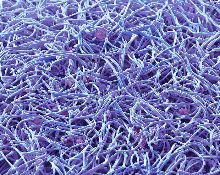 Human Metapneumovirus  HMPV , SEM Human Metapneumovirus  HMPV  strain isolate TN 93 32 group B2. Scanning electron micrograph  SEM  of an African Green Monkey Kidney Epithelial cell  Vero cell line  infected with HMPV for 3 days. The image shows a sea of long filamentous enveloped particles  Blue shades  obscuring the plasma membrane of the infected cells. These infections can cause  cold like  symptoms similar to other viruses that cause upper and lower respiratory infections  RSV, Rhinovirus, Influenza  ranging from mild symptoms such as cough, fever, nasal congestion, and shortness of breath to more severe bronchitis or pneumonia. Magnification: 5000 x when printed 10 centimetres wide. Specimen courtesy of Virology Research Services Ltd  Scott Lawrence ., by STEVE GSCHMEISSNER SCIENCE PHOTO LIBRARY