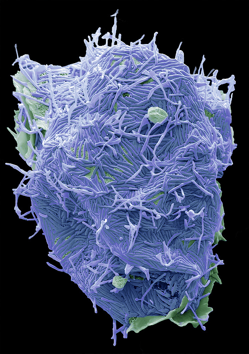 Human Metapneumovirus  HMPV , SEM Human Metapneumovirus  HMPV . Scanning electron micrograph  SEM  of an African Green Monkey Kidney Epithelial cell  Vero cell line  infected with HMPV for 48 hours. The image shows an infected cell with long filamentous enveloped particles  blue  emerging horizontally and vertically from the plasma membrane. These infections can cause  cold like  symptoms similar to other viruses that cause upper and lower respiratory infections  RSV, Rhinovirus, Influenza  ranging from mild symptoms such as cough, fever, nasal congestion, and shortness of breath to more severe bronchitis or pneumonia. Magnification: 5000 x when printed 10 centimetres wide., by STEVE GSCHMEISSNER SCIENCE PHOTO LIBRARY