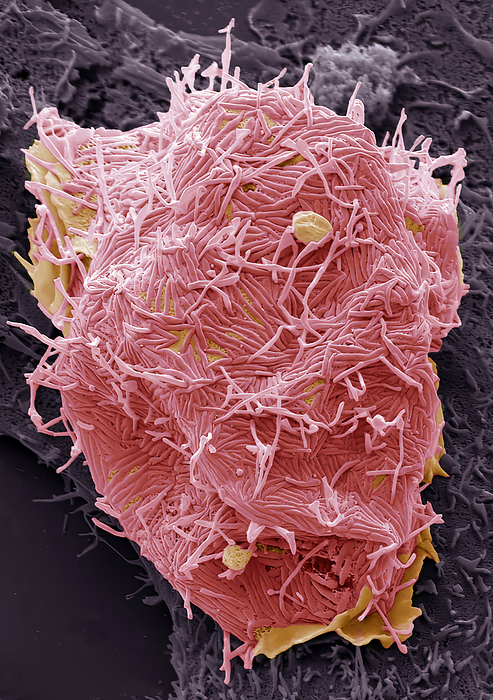 Human Metapneumovirus  HMPV , SEM Human Metapneumovirus  HMPV . Scanning electron micrograph  SEM  of an African Green Monkey Kidney Epithelial cell  Vero cell line  infected with HMPV for 48 hours. The image shows an infected cell with long filamentous enveloped particles  Pink  emerging horizontally and vertically from the plasma membrane. These infections can cause  cold like  symptoms similar to other viruses that cause upper and lower respiratory infections  RSV, Rhinovirus, Influenza  ranging from mild symptoms such as cough, fever, nasal congestion, and shortness of breath to more severe bronchitis or pneumonia. Magnification: 5000 x when printed 10 centimetres wide., by STEVE GSCHMEISSNER SCIENCE PHOTO LIBRARY