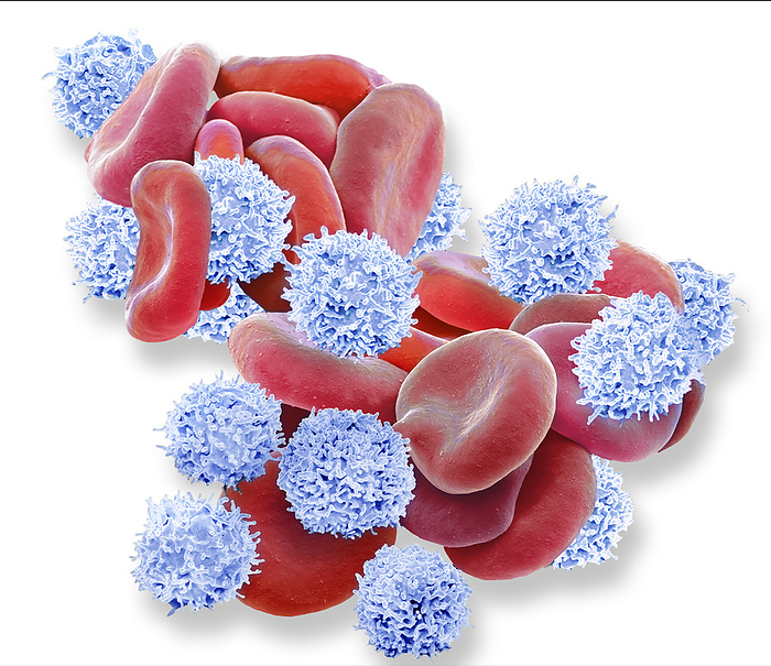 Leukaemia, SEM Leukaemia blood cells. Composite coloured scanning electron micrograph  SEM  of blood cells from chronic lymphocytic leukaemia, a form of cancer. The disease results from an increase in circulating levels of white blood cells  lymphocytes . This causes a reduction in red blood cells  erythrocytes, red  and other blood components. Chronic lymphocytic leukaemia may develop slowly over several years with no symptoms, but it can cause enlargement of the liver and spleen, and anaemia. Treatment in severe cases includes anti cancer drugs and radiotherapy, with antibiotics to combat infection. Magnification: x4000 when printed at 10 centimetres wide., by STEVE GSCHMEISSNER SCIENCE PHOTO LIBRARY