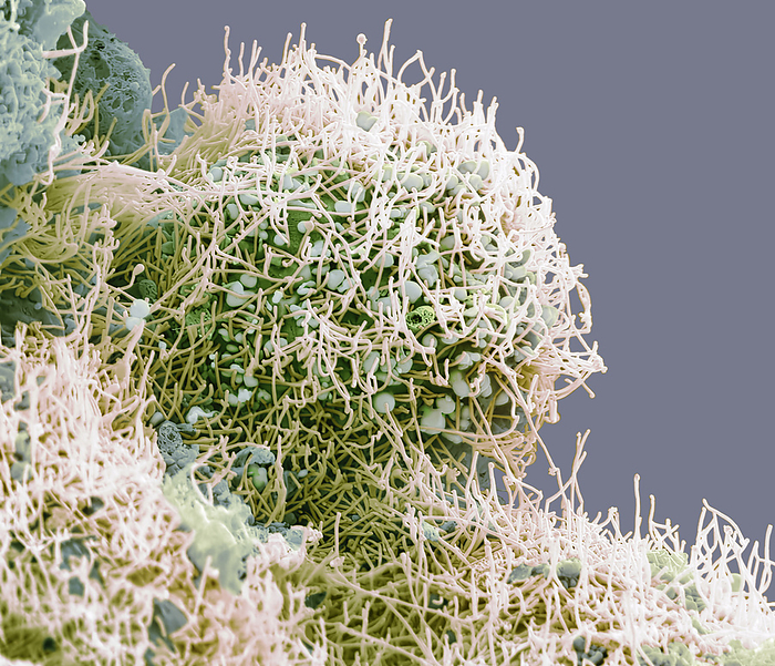 Human Metapneumovirus  HMPV , SEM Human Metapneumovirus  HMPV  Scanning electron micrograph  SEM  of an African Green Monkey Kidney Epithelial cells  Vero cell line  infected with HMPV for 3 days. The image shows an infected cells with long filamentous enveloped particles emerging from the plasma membrane. These infections can cause  cold like  symptoms similar to other viruses that cause upper and lower respiratory infections  RSV, Rhinovirus, Influenza  ranging from mild symptoms such as cough, fever, nasal congestion, and shortness of breath to more severe bronchitis or pneumonia. Magnification: 3000 x when printed 10 centimetres wide., by STEVE GSCHMEISSNER SCIENCE PHOTO LIBRARY