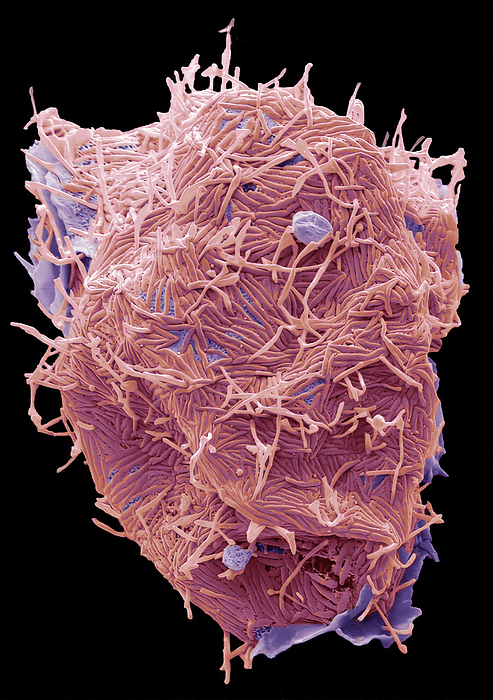 Human Metapneumovirus  HMPV , SEM Human Metapneumovirus  HMPV . Scanning electron micrograph  SEM  of an African Green Monkey Kidney Epithelial cell  Vero cell line  infected with HMPV for 48 hours. The image shows an infected cell with long filamentous enveloped particles  Pink  emerging horizontally and vertically from the plasma membrane. These infections can cause  cold like  symptoms similar to other viruses that cause upper and lower respiratory infections  RSV, Rhinovirus, Influenza  ranging from mild symptoms such as cough, fever, nasal congestion, and shortness of breath to more severe bronchitis or pneumonia. Magnification: 5000 x when printed 10 centimetres wide., by STEVE GSCHMEISSNER SCIENCE PHOTO LIBRARY