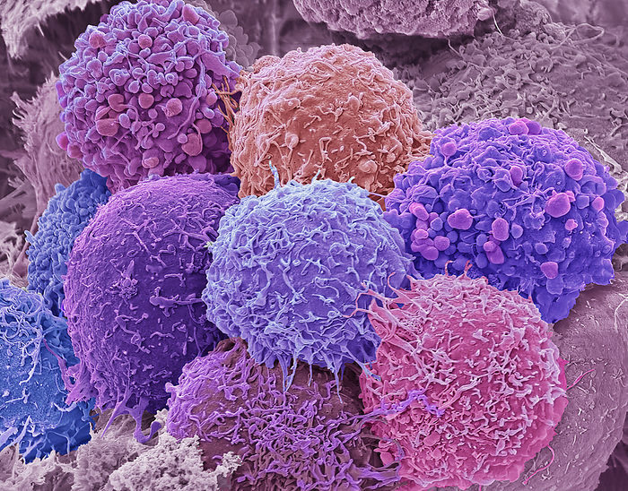 Hela cells, SEM HeLa cells. Coloured scanning electron micrograph  SEM  of a HeLa cells. HeLa cells are a continuously cultured cell line of immortal human cancer cells derived from cervical cancer cells. As they are immortal they thrive in the laboratory and are widely used in biological and medical research. Since being discovered in the 1950s, experiments on HeLa cells have played a role in developing advances like the polio and COVID 19 vaccines, treatments for cancer, HIV, AIDS, and much more. About 55 million tons of these cells have been used in over 75, 000 scientific studies around the world. Cancer of the cervix  the neck of the uterus  is one of the most common cancers affecting women. Magnification: x3500 when printed at 10 centimetres wide., by STEVE GSCHMEISSNER SCIENCE PHOTO LIBRARY