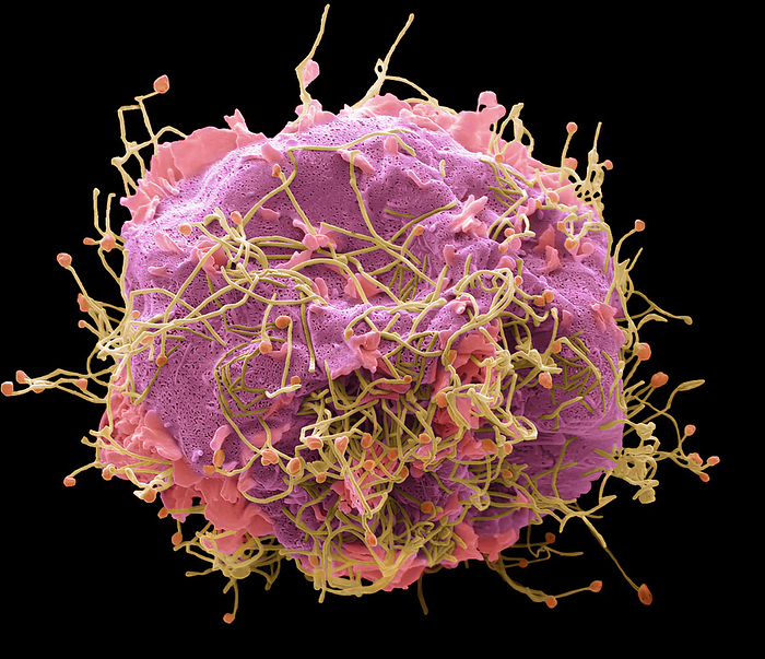 Human Metapneumovirus  HMPV , SEM Human Metapneumovirus  HMPV  Scanning electron micrograph  SEM  of an African Green Monkey Kidney Epithelial cell  Vero cell line  infected with HMPV for 3 days. The image shows an infected cell with long filamentous enveloped particles  Yellow  emerging from the plasma membrane. These infections can cause  cold like  symptoms similar to other viruses that cause upper and lower respiratory infections  RSV, Rhinovirus, Influenza  ranging from mild symptoms such as cough, fever, nasal congestion, and shortness of breath to more severe bronchitis or pneumonia. Magnification: 3000 x when printed 10 centimetres wide., by STEVE GSCHMEISSNER SCIENCE PHOTO LIBRARY