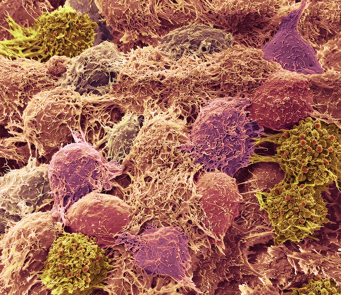 Hela cells, SEM HeLa cells. Coloured scanning electron micrograph  SEM  of a HeLa cells. HeLa cells are a continuously cultured cell line of immortal human cancer cells derived from cervical cancer cells. As they are immortal they thrive in the laboratory and are widely used in biological and medical research. Since being discovered in the 1950s, experiments on HeLa cells have played a role in developing advances like the polio and COVID 19 vaccines, treatments for cancer, HIV, AIDS, and much more. About 55 million tons of these cells have been used in over 75, 000 scientific studies around the world. Cancer of the cervix  the neck of the uterus  is one of the most common cancers affecting women. Magnification: x1500 when printed at 10 centimetres wide., by STEVE GSCHMEISSNER SCIENCE PHOTO LIBRARY