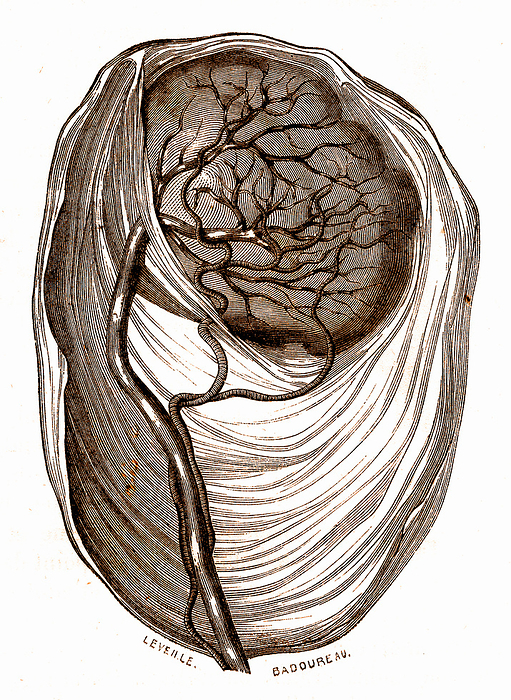 Marginal cord insertion of the placenta, 19th century illustration Illustration showing a marginal cord insertion of the placenta. The placenta is the temporary organ that connects a developing foetus to its mother via the umbilical cord. Usually the cord is attached to the centre of the placenta, but in a marginal cord insertion it is attached at the edge. This attachment can lead to complications including preterm delivery, foetal growth restriction and foetal distress. From New Dictionary of Practical Medicine and Surgery by Dr Jaccoud Vol. 9  1869 ., by COLLECTION ABECASIS SCIENCE PHOTO LIBRARY