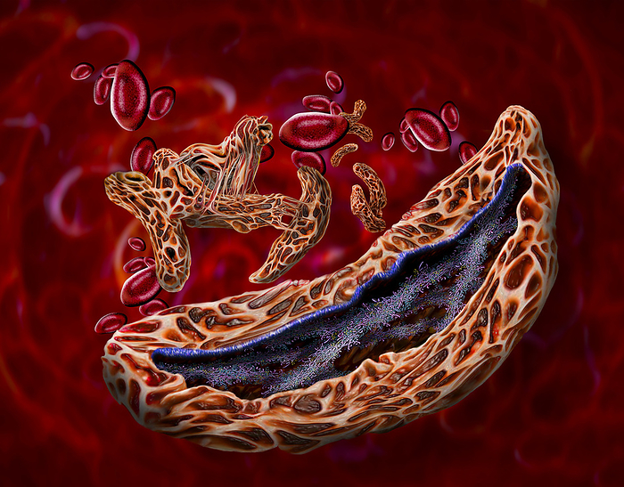 Sickle cell anaemia, illustration Illustration of red blood cells affected by sickle cell anaemia  brown  and some healthy red blood cells  red . Sickle cell anaemia is an inherited blood disease in which the red blood cells contain an abnormal form of haemoglobin  blood s oxygen carrying pigment, blue and pink  that causes the blood cells to become sickle shaped, rather than round. Sickle cells cannot move through small blood vessels as easily as normal cells and so can cause blockages. This prevents oxygen from reaching the tissues, causing severe pain and organ damage., by KEITH CHAMBERS SCIENCE PHOTO LIBRARY