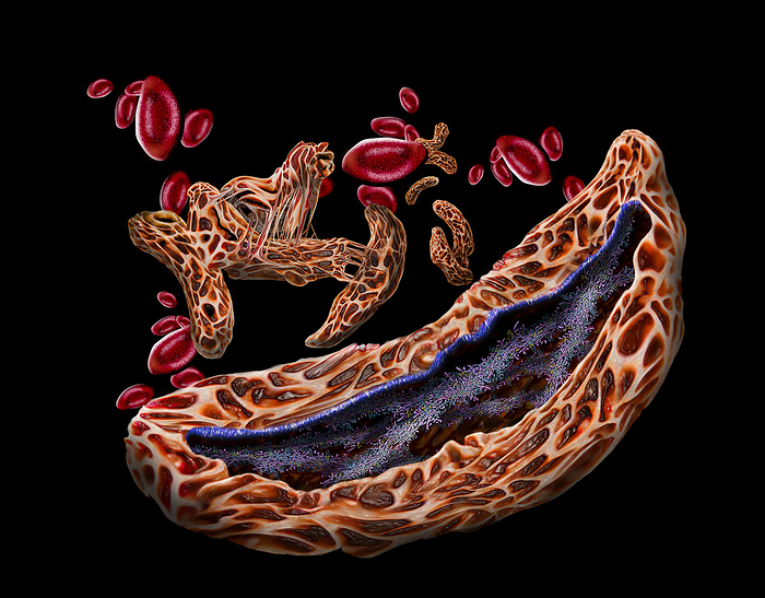 Sickle cell anaemia, illustration Illustration of red blood cells affected by sickle cell anaemia  brown  and some healthy red blood cells  red . Sickle cell anaemia is an inherited blood disease in which the red blood cells contain an abnormal form of haemoglobin  blood s oxygen carrying pigment, blue and pink  that causes the blood cells to become sickle shaped, rather than round. Sickle cells cannot move through small blood vessels as easily as normal cells and so can cause blockages. This prevents oxygen from reaching the tissues, causing severe pain and organ damage., by KEITH CHAMBERS SCIENCE PHOTO LIBRARY