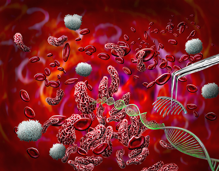 CRISPR treatment for sickle cell anaemia, conceptual illustration CRISPR treatment for sickle cell anaemia, conceptual illustration. Red blood cells affected by sickle cell anaemia  red and white  having their DNA  deoxyribonucleic acid, green double helix  repaired using CRISPR Cas9 gene editing. Sickle cell anaemia is an inherited blood disease in which the red blood cells contain an abnormal form of haemoglobin  blood s oxygen carrying pigment  that causes the blood cells to become sickle shaped, rather than round. Sickle cells cannot move through small blood vessels as easily as normal cells and so can cause blockages. This prevents oxygen from reaching the tissues, causing severe pain and organ damage. The first CRISPR treatments for sickle cell anaemia were approved in the UK and USA at the end of 2023., by KEITH CHAMBERS SCIENCE PHOTO LIBRARY