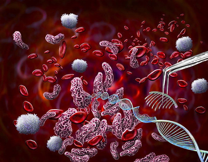 CRISPR treatment for sickle cell anaemia, conceptual illustration CRISPR treatment for sickle cell anaemia, conceptual illustration. Red blood cells affected by sickle cell anaemia  red and white  having their DNA  deoxyribonucleic acid, blue double helix  repaired using CRISPR Cas9 gene editing. Sickle cell anaemia is an inherited blood disease in which the red blood cells contain an abnormal form of haemoglobin  blood s oxygen carrying pigment  that causes the blood cells to become sickle shaped, rather than round. Sickle cells cannot move through small blood vessels as easily as normal cells and so can cause blockages. This prevents oxygen from reaching the tissues, causing severe pain and organ damage. The first CRISPR treatments for sickle cell anaemia were approved in the UK and USA at the end of 2023., by KEITH CHAMBERS SCIENCE PHOTO LIBRARY