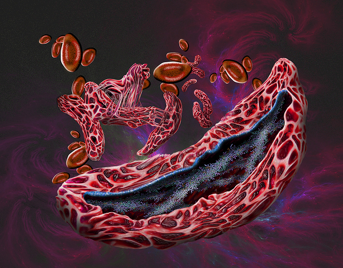 Sickle cell anaemia, illustration Illustration of red blood cells affected by sickle cell anaemia  foreground  and some healthy red blood cells  background . Sickle cell anaemia is an inherited blood disease in which the red blood cells contain an abnormal form of haemoglobin  blood s oxygen carrying pigment, green and purple  that causes the blood cells to become sickle shaped, rather than round. Sickle cells cannot move through small blood vessels as easily as normal cells and so can cause blockages. This prevents oxygen from reaching the tissues, causing severe pain and organ damage., by KEITH CHAMBERS SCIENCE PHOTO LIBRARY