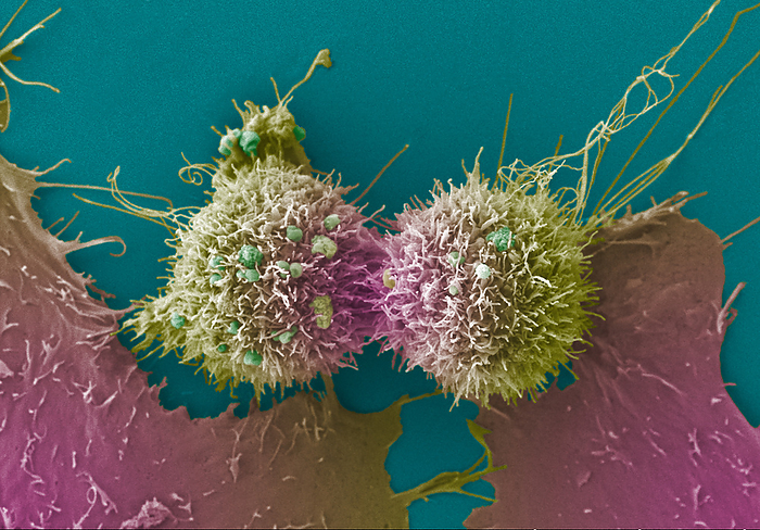 Cervical cancer cells dividing, SEM Cervical cancer cell, coloured scanning electron micrograph  SEM . The cervix is the lower part of the womb, also called the neck of the womb, and comprises part of the woman s reproductive system. Cervical cancer is more common in younger women. One of the main causes of cervical cancer is a persistent infection of certain types of human papilloma virus  HPV . In this image the central cells are undergoing cell division which is where the parental cell divides into two daughter cells. Cancer cells often divide and multiply uncontrollably which can lead to the formation of tumours. These cells also have long extending filopodia like structures. Filopodia contain actin filaments and can have roles in numerous processes including cell cell interactions, cell migration or as a sensory guide towards a chemoattractant, which is a chemical agent that induces a cell to migrate towards it. There is also a small amount of blebbing. Blebbing is a bulge or protrusion of the plasma membrane of the cell which is visible on the cell surface. Blebbing may occur for a number of different reasons including during apoptosis, or if a cell is undergoing physical or chemical stress. It also has important functions in cellular processes such as cell division and cell locomotion, playing a role in cell migration. Magnification: x2800 when printed at 10 cm wide., by ANNE E. WESTON SCIENCE PHOTO LIBRARY