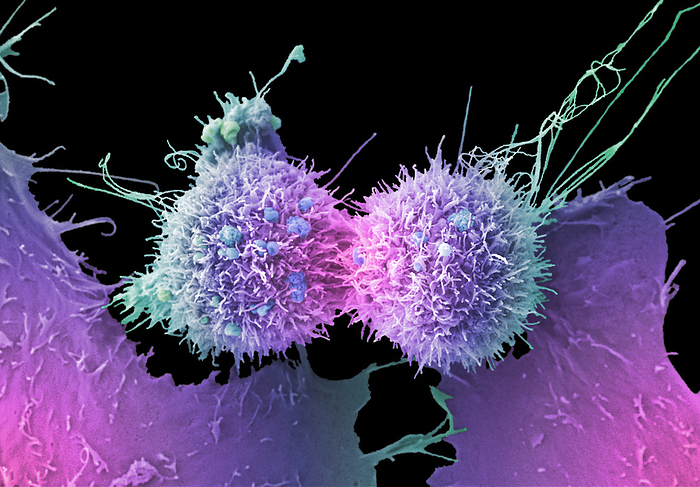 Cervical cancer cells dividing, SEM Cervical cancer cell, coloured scanning electron micrograph  SEM . The cervix is the lower part of the womb, also called the neck of the womb, and comprises part of the woman s reproductive system. Cervical cancer is more common in younger women. One of the main causes of cervical cancer is a persistent infection of certain types of human papilloma virus  HPV . In this image the central cells are undergoing cell division which is where the parental cell divides into two daughter cells. Cancer cells often divide and multiply uncontrollably which can lead to the formation of tumours. These cells also have long extending filopodia like structures. Filopodia contain actin filaments and can have roles in numerous processes including cell cell interactions, cell migration or as a sensory guide towards a chemoattractant, which is a chemical agent that induces a cell to migrate towards it. There is also a small amount of blebbing. Blebbing is a bulge or protrusion of the plasma membrane of the cell which is visible on the cell surface. Blebbing may occur for a number of different reasons including during apoptosis, or if a cell is undergoing physical or chemical stress. It also has important functions in cellular processes such as cell division and cell locomotion, playing a role in cell migration. Magnification: x2800 when printed at 10 cm wide., by ANNE E. WESTON SCIENCE PHOTO LIBRARY