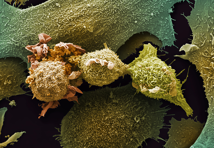 Lung cancer cells, SEM Lung cancer cells, coloured scanning electron micrograph  SEM . Lung cancer occurs when abnormal cells divide in a chaotic and uncontrolled manner resulting in the formation of a tumour in the lungs. It is more commonly found in older people and one of the most common factors associated with getting lung cancer is smoking. Other causes or risks associated with getting lung cancer are exposure to chemicals or pollutants or a family history of lung cancer. The central cells in this image are displaying membrane ruffling, also known as cell ruffling. This is the formation of actin rich membrane protrusions and often precedes the formation of lamellipodia so is frequently a characteristic feature of actively migrating cells. Cell migration plays an important role in cancer development and metastasis. Magnification: x2000 when printed at 10 cm wide., by ANNE E. WESTON SCIENCE PHOTO LIBRARY