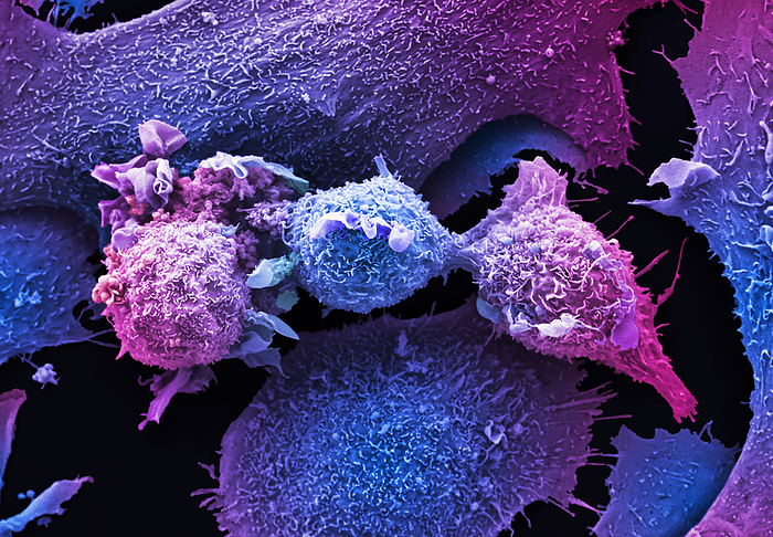 Lung cancer cells, SEM Lung cancer cells, coloured scanning electron micrograph  SEM . Lung cancer occurs when abnormal cells divide in a chaotic and uncontrolled manner resulting in the formation of a tumour in the lungs. It is more commonly found in older people and one of the most common factors associated with getting lung cancer is smoking. Other causes or risks associated with getting lung cancer are exposure to chemicals or pollutants or a family history of lung cancer. The central cells in this image are displaying membrane ruffling, also known as cell ruffling. This is the formation of actin rich membrane protrusions and often precedes the formation of lamellipodia so is frequently a characteristic feature of actively migrating cells. Cell migration plays an important role in cancer development and metastasis. Magnification: x2000 when printed at 10 cm wide., by ANNE E. WESTON SCIENCE PHOTO LIBRARY