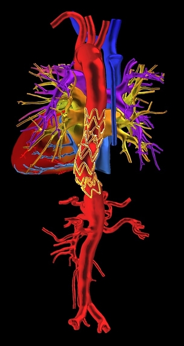 Aortic aneurysm stent, CT scan Coloured 3D computed tomography  CT  scan of the heart  centre left  and aorta  body s main artery, large red tube  of a patient who has had a stent  gold mesh  placed in an aortic aneurysm. A stent is a tube implanted into blood vessels to prevent narrowing and provide structural support, in this case to prevent the aneurysm  from rupturing. An aneurysm is a bulging of a section of blood vessel which can occur when the blood vessel wall becomes weakened and thin. The exact cause is not fully known but risk factors include smoking, age, genetics and high blood pressure. Symptoms vary depending on where the aneurysm occurs, but generally include pain in the affected area. In some cases, aneurysms can rupture, which can lead to severe internal bleeding and death. Stents can avoid the need for more invasive surgical treatment to prevent this., by K H FUNG SCIENCE PHOTO LIBRARY