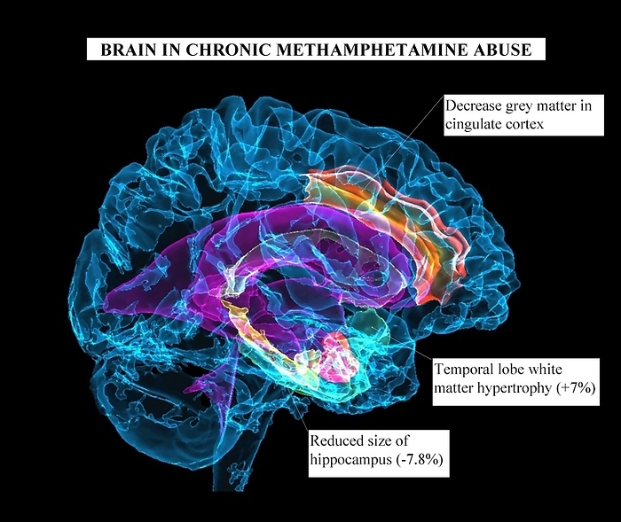 Brain affected by chronic methamphetamine abuse, MRI scan Coloured 3D magnetic resonance imaging  MRI  scan of a brain affected by chronic methamphetamine abuse. There is a reduction in grey matter in the anterior cingulate cortex  orange , an area of the brain involved in complex cognitive functions including impulse control, decision making and empathy. There is also a reduction in the size of the hippocampus  yellow , which is responsible for long term memory and an increase in white matter in the temporal lobe  green , which is involved in auditory processing, speech and language functions. Methamphetamine is a stimulant and euphoriant drug that is illegal in most countries. Frequent use of the drug can lead to addiction and dependence., by K H FUNG SCIENCE PHOTO LIBRARY