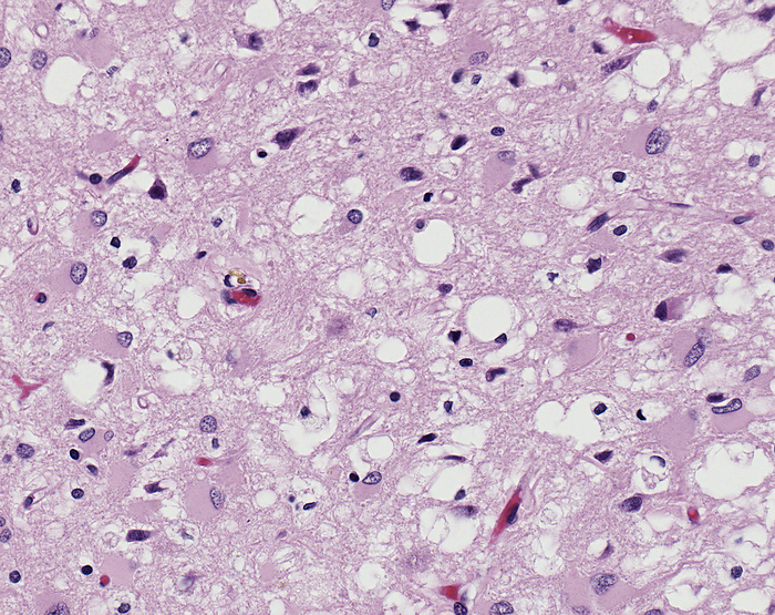 Brain in Creutzfeldt Jakob disease, light micrograph Light micrograph of a section through a brain infected with variant Creutzfeldt Jakob disease  vCJD  showing a loss of neurons  nerve cells , seen as white spaces. The disease is the result of virus like prions within the brain that cause vacuoles and plaques to form, making the brain spongy and killing off the tissue. Symptoms include dementia and sudden muscle contractions, leading to death. The similarly fatal cattle disease BSE  bovine spongiform encephalopathy  has been linked to human vCJD., by CDC Sherif Zaki,Wun Ju Shieh SCIENCE PHOTO LIBRARY