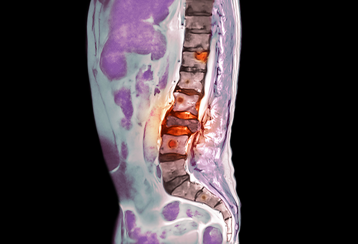 Metastatic lung cancer, MRI scan Coloured magnetic resonance imaging  MRI  scan showing the thorax and spine  right  of a 60 year old man with bronchial carcinoma  lung cancer  that has spread  metastasised  to the spine, forming secondary tumours  red spots in spine . Metastasis occurs when cells from a tumour break off and are transported to other parts of the body via blood or lymph vessels. This is also known as advanced cancer, or stage 4 cancer. At this stage it can not always be cured but radiotherapy and chemotherapy can be used to control symptoms., by DR P. MARAZZI SCIENCE PHOTO LIBRARY