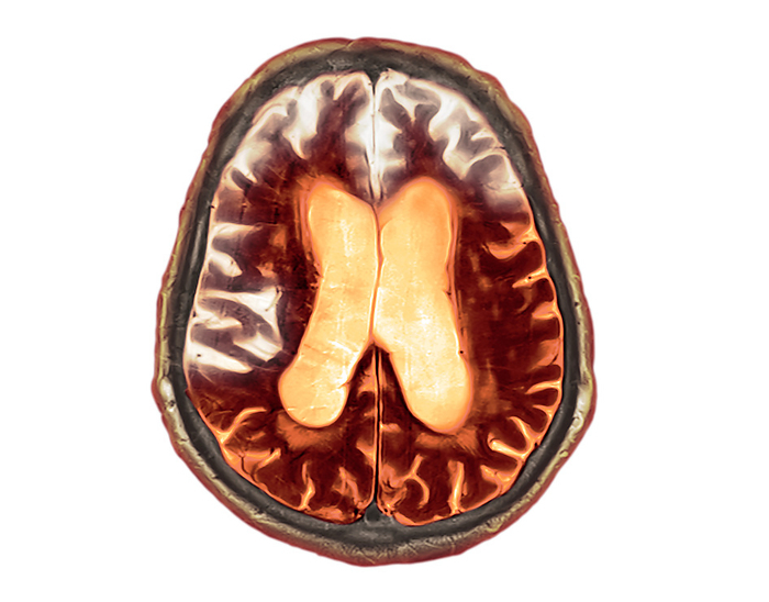 Frontotemporal dementia, MRI and CT scans Combined coloured magnetic resonance imaging  MRI  and computed tomography  CT  scans showing the brain of a 90 year old man with advanced frontotemporal dementia. This is a condition in which clumps of abnormal proteins form in the frontotemporal  front and side  brain, leading to cell death and brain atrophy  white . Dementia leads to the deterioration of mental abilities, unusual or irrational behaviour and memory loss. This form particularly affects the ability to produce and comprehend speech, but memory loss tends to occur at a later stage than in more common forms of dementia. There is currently no cure nor means of slowing the progression of dementia, but therapy may be offered to help with speech and movement., by DR P. MARAZZI SCIENCE PHOTO LIBRARY