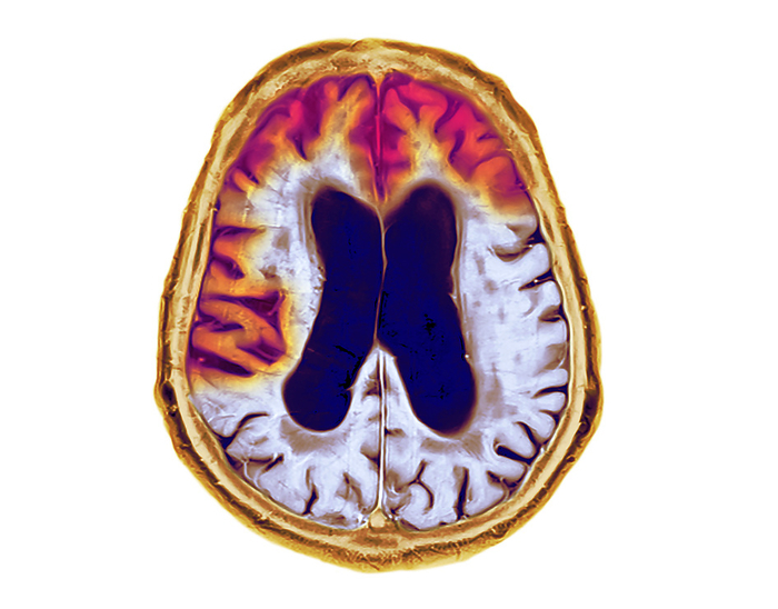 Frontotemporal dementia, MRI and CT scans Combined coloured magnetic resonance imaging  MRI  and computed tomography  CT  scans showing the brain of a 90 year old man with advanced frontotemporal dementia. This is a condition in which clumps of abnormal proteins form in the frontotemporal  front and side  brain, leading to cell death and brain atrophy  red . Dementia leads to the deterioration of mental abilities, unusual or irrational behaviour and memory loss. This form particularly affects the ability to produce and comprehend speech, but memory loss tends to occur at a later stage than in more common forms of dementia. There is currently no cure nor means of slowing the progression of dementia, but therapy may be offered to help with speech and movement., by DR P. MARAZZI SCIENCE PHOTO LIBRARY