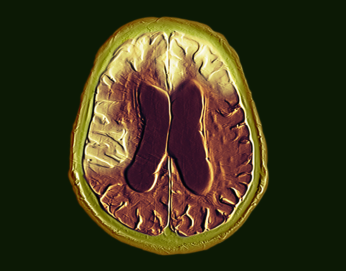 Frontotemporal dementia, MRI and CT scans Combined coloured magnetic resonance imaging  MRI  and computed tomography  CT  scans showing the brain of a 90 year old man with advanced frontotemporal dementia. This is a condition in which clumps of abnormal proteins form in the frontotemporal  front and side  brain, leading to cell death and brain atrophy  yellow . Dementia leads to the deterioration of mental abilities, unusual or irrational behaviour and memory loss. This form particularly affects the ability to produce and comprehend speech, but memory loss tends to occur at a later stage than in more common forms of dementia. There is currently no cure nor means of slowing the progression of dementia, but therapy may be offered to help with speech and movement., by DR P. MARAZZI SCIENCE PHOTO LIBRARY