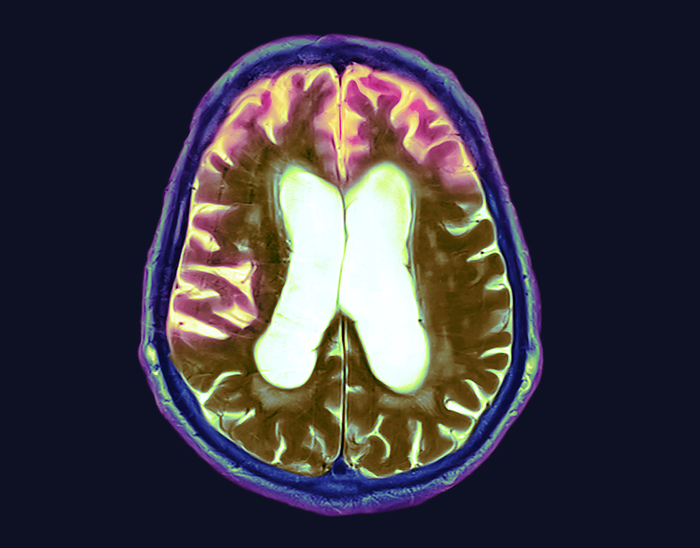 Frontotemporal dementia, MRI and CT scans Combined coloured magnetic resonance imaging  MRI  and computed tomography  CT  scans showing the brain of a 90 year old man with advanced frontotemporal dementia. This is a condition in which clumps of abnormal proteins form in the frontotemporal  front and side  brain, leading to cell death and brain atrophy  pink . Dementia leads to the deterioration of mental abilities, unusual or irrational behaviour and memory loss. This form particularly affects the ability to produce and comprehend speech, but memory loss tends to occur at a later stage than in more common forms of dementia. There is currently no cure nor means of slowing the progression of dementia, but therapy may be offered to help with speech and movement., by DR P. MARAZZI SCIENCE PHOTO LIBRARY