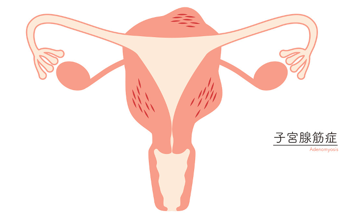 Diagrammatic illustration of adenomyosis, anatomy of the uterus and ovaries