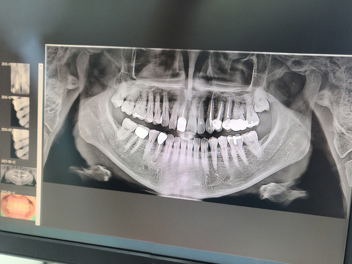 x-ray image of human teeth