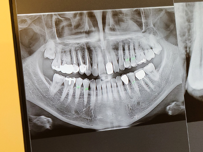x-ray image of human teeth