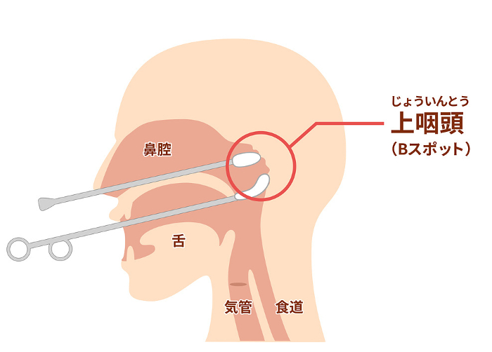 How to perform and illustrate nasopharyngeal abrasion treatment (B-spot treatment)