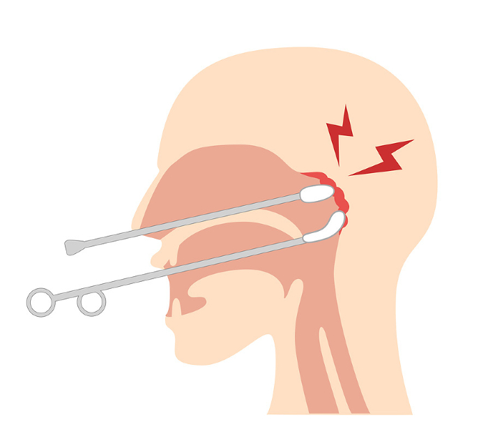How to perform and illustrate nasopharyngeal abrasion treatment (B-spot treatment)