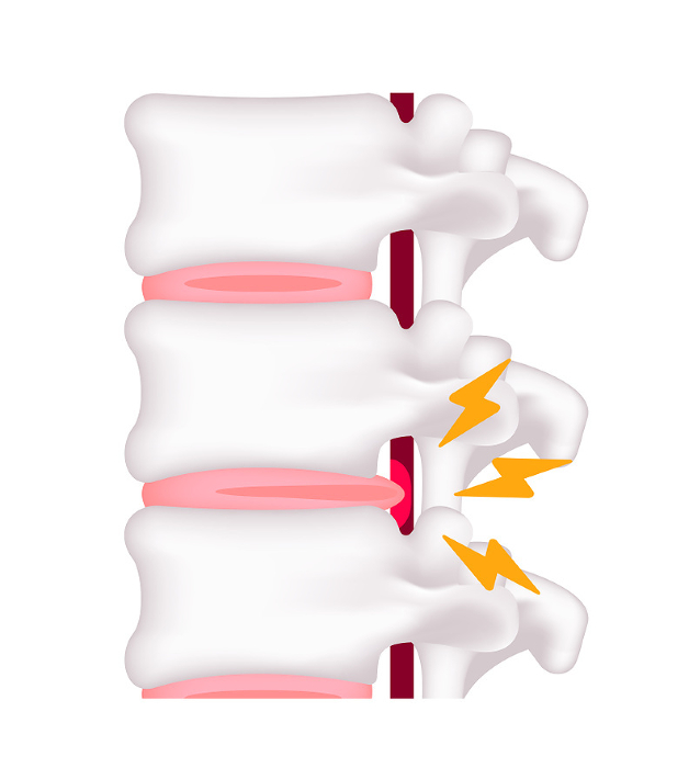 Causes of herniated disc Vector illustration