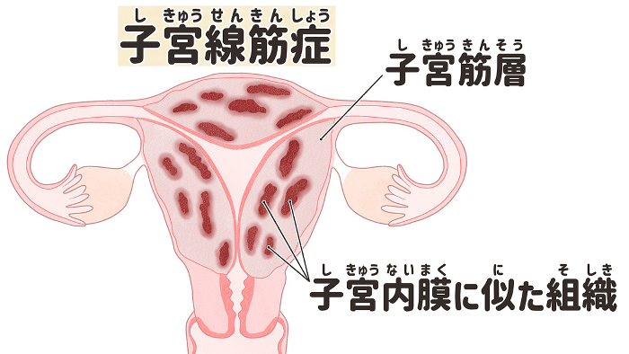 Uterine fibrosis Easy-to-understand illustrations in Japanese