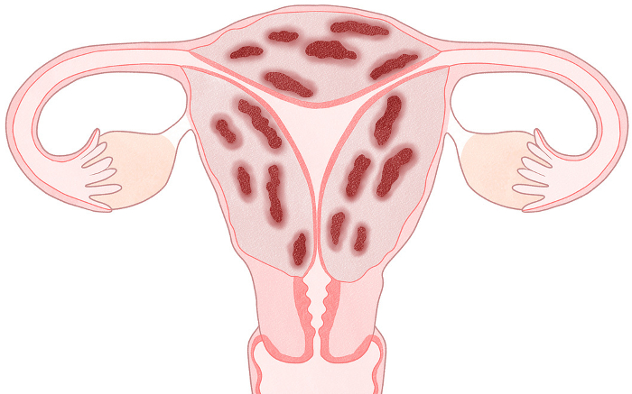 Uterine fibrosis Easy-to-understand illustrations